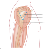 Illustration av en överarms muskler.