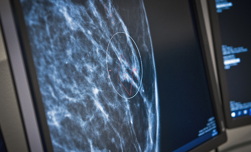 Röntgenbild mammografin